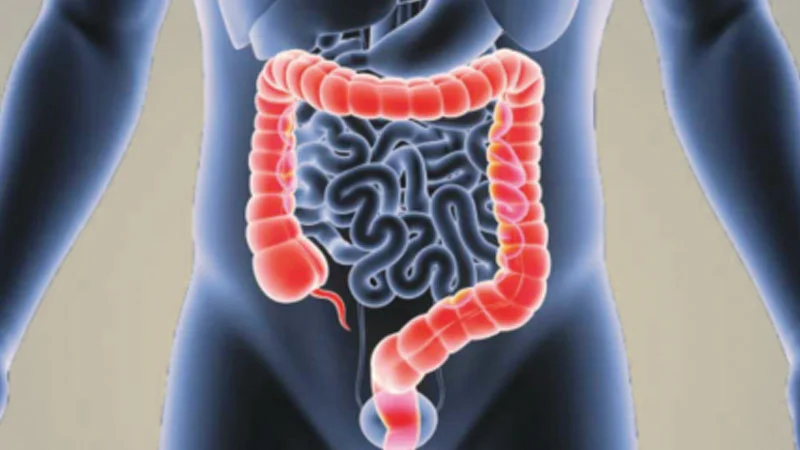 কোলন ক্যান্সার কীভাবে বুঝবেন