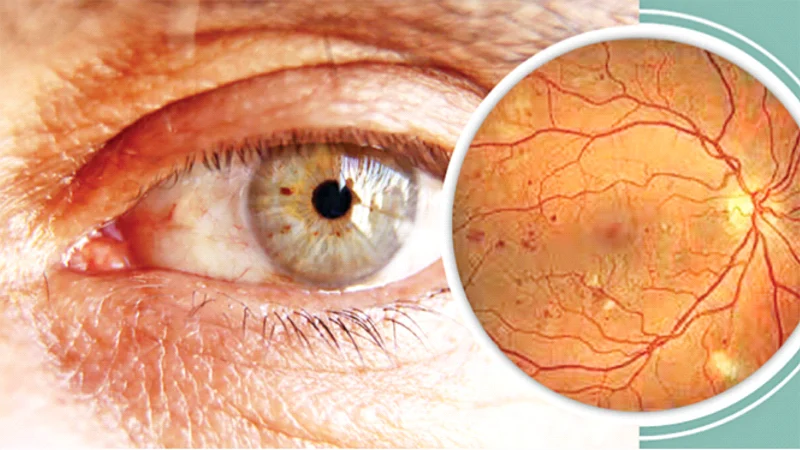 ডায়াবেটিস ও চোখ জটিলতা ও প্রতিরোধ