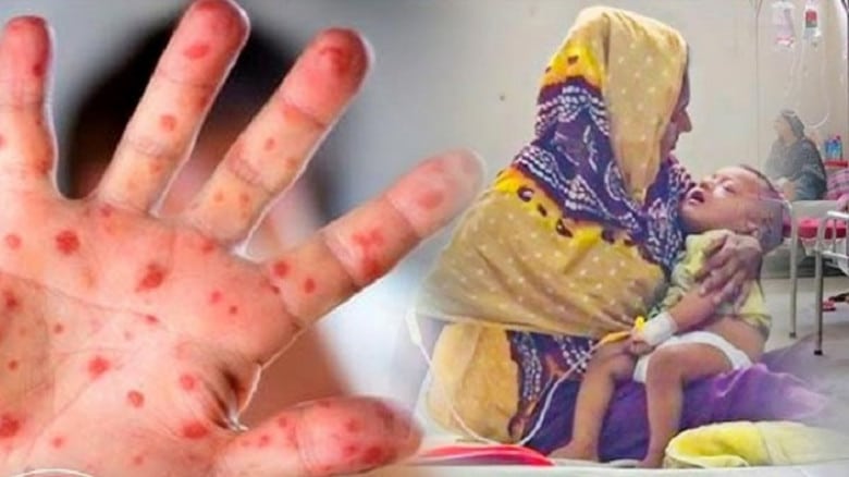 দেশে হাম ও উপসর্গ নিয়ে আরও ৫ জনের মৃত্যু