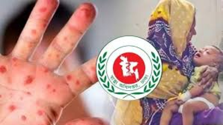 হামের উপসর্গ নিয়ে আরও পাঁচজনের মৃত্যু