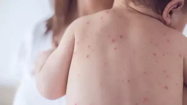 ২৪ ঘণ্টায় হামে ২ মৃত্যু, হাসপাতালে ভর্তি ৬০