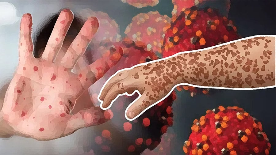 ২৪ ঘণ্টায় হামে প্রাণ গেল আরও ৫ শিশুর, ৮ শত ছুঁইছুঁই